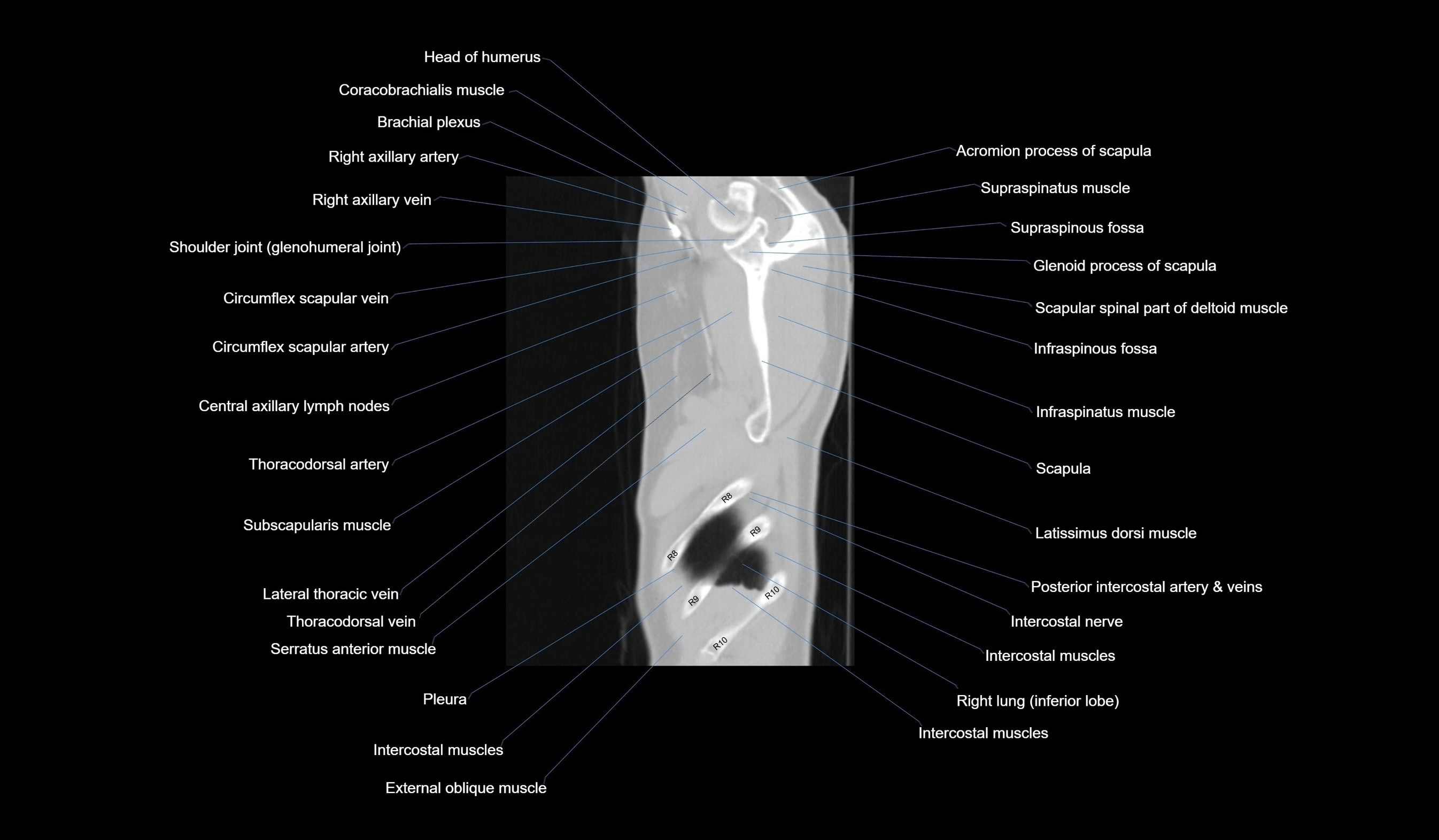 CT chest (thorax) lung window labelled sagittal cross sectional anatomy radiology image-00014.webp